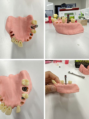 第3回 インプラントベーシック02