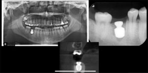 第3回 インプラント症例検討会02